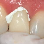 Gc Freegenol 1-1 Pkg - Image 4