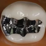 Waldent WalCap Amalgam Capsules - Image 11