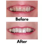 Bioclear 360° Veneer Matrices Pack of 12 - Image 4